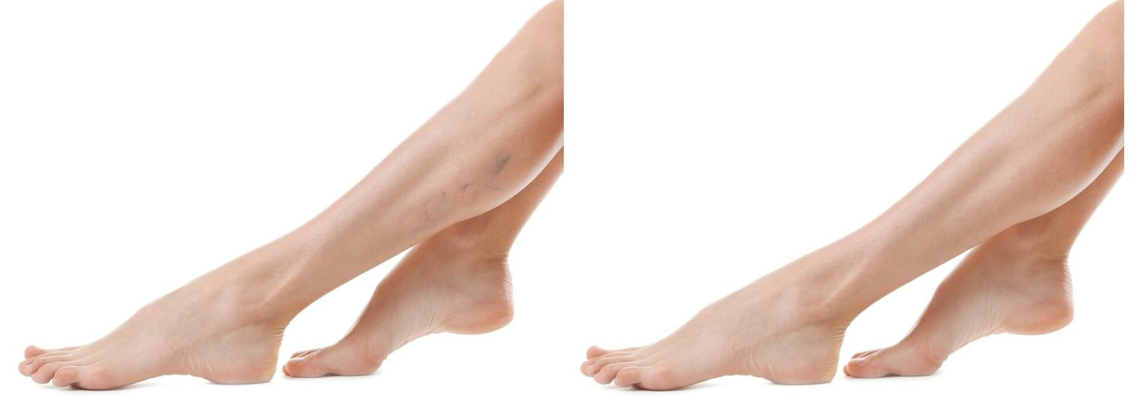 Say Goodbye to Unsightly Veins: The Benefits of Fotona Laser Vein Removal