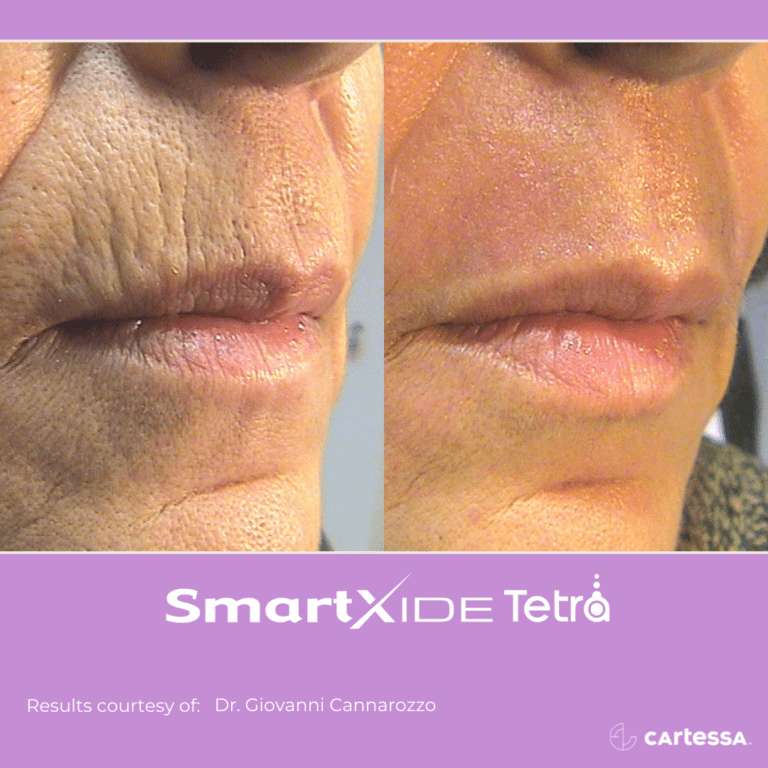 Before and after lip filler treatment.