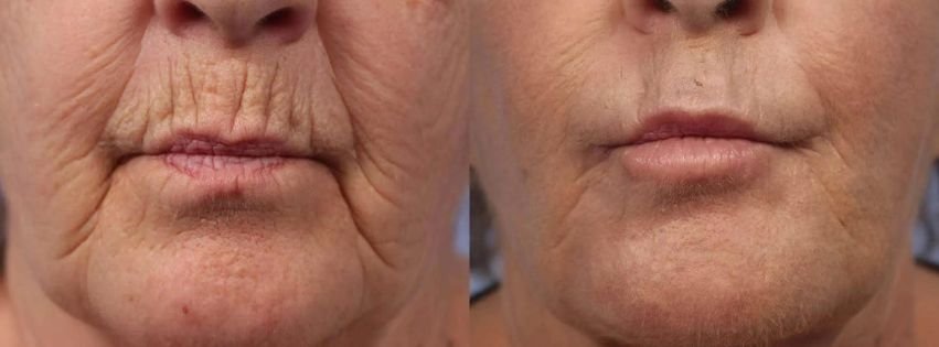 Unlocking Radiant Beauty: Exploring Factora by InMode