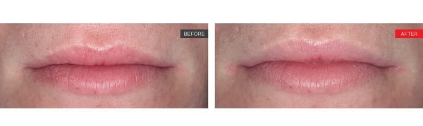 Enhance Your Lips with Fotona