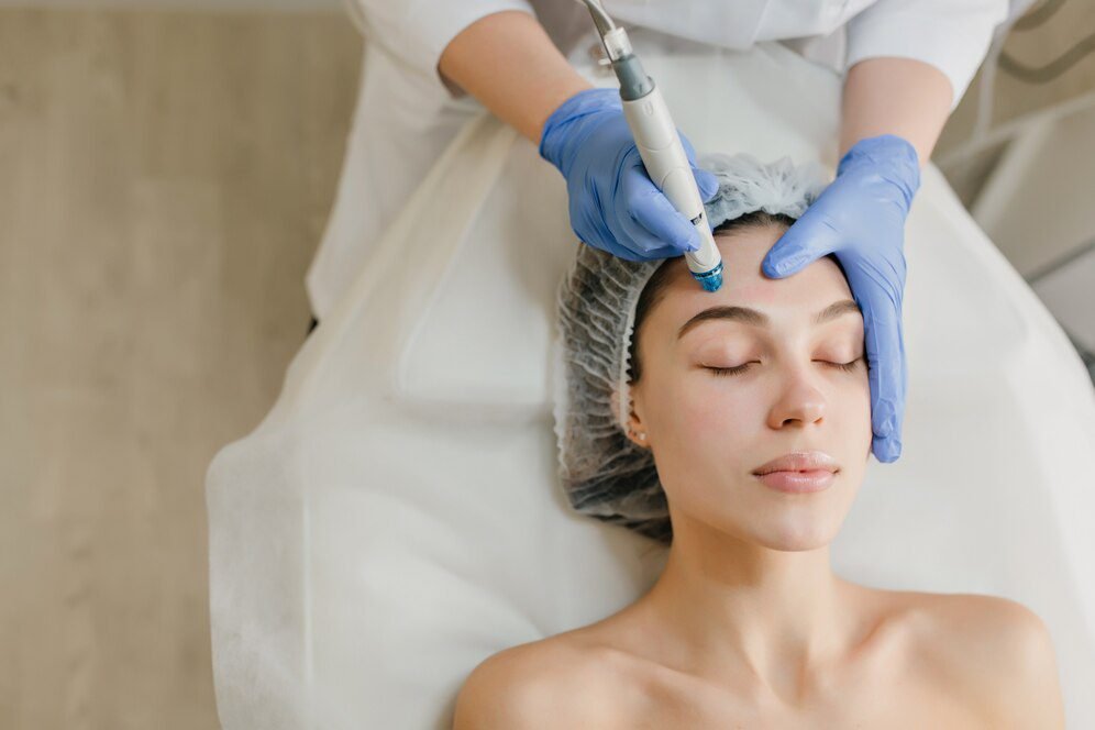 Laser Acne Treatment vs. Traditional Acne Treatments: Why Choose New Age Laser in Cambridge? 