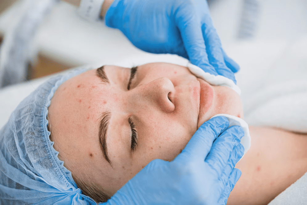 New Age Laser Clinic | Medical Spa & Laser Clinic|Laser Acne Treatment Hamilton
