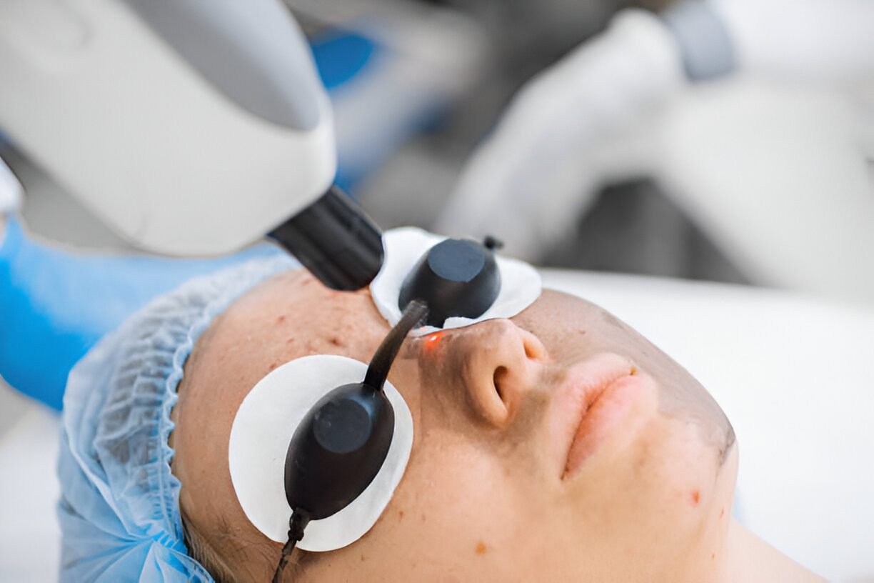 Achieve Acne-Free Skin Faster with Face Laser Acne Treatment 