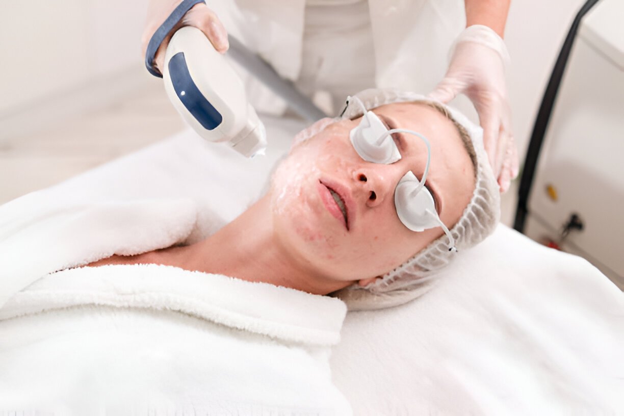 The Truth About Laser Acne Treatment: Myths and Facts Unveiled 