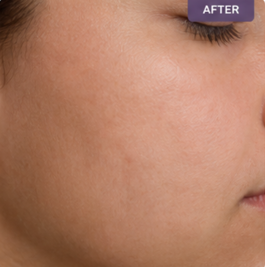 hair removal