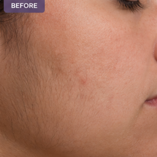 laser hair removal