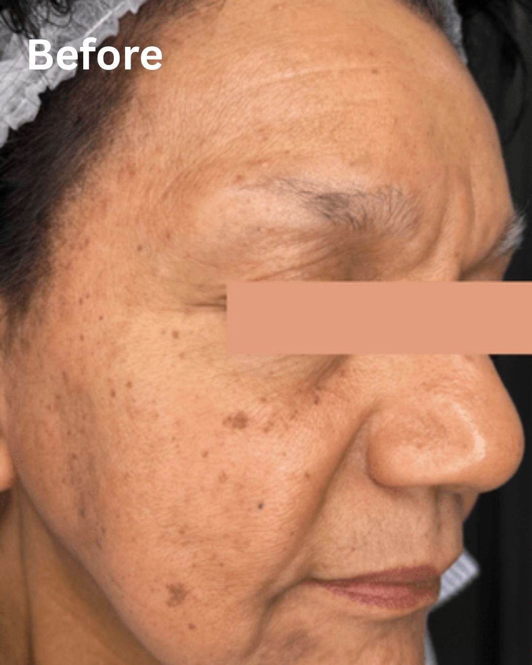 New Age Laser Clinic | Medical Spa & Laser Clinic | CoolPeel® with Tetra CO2 Laser