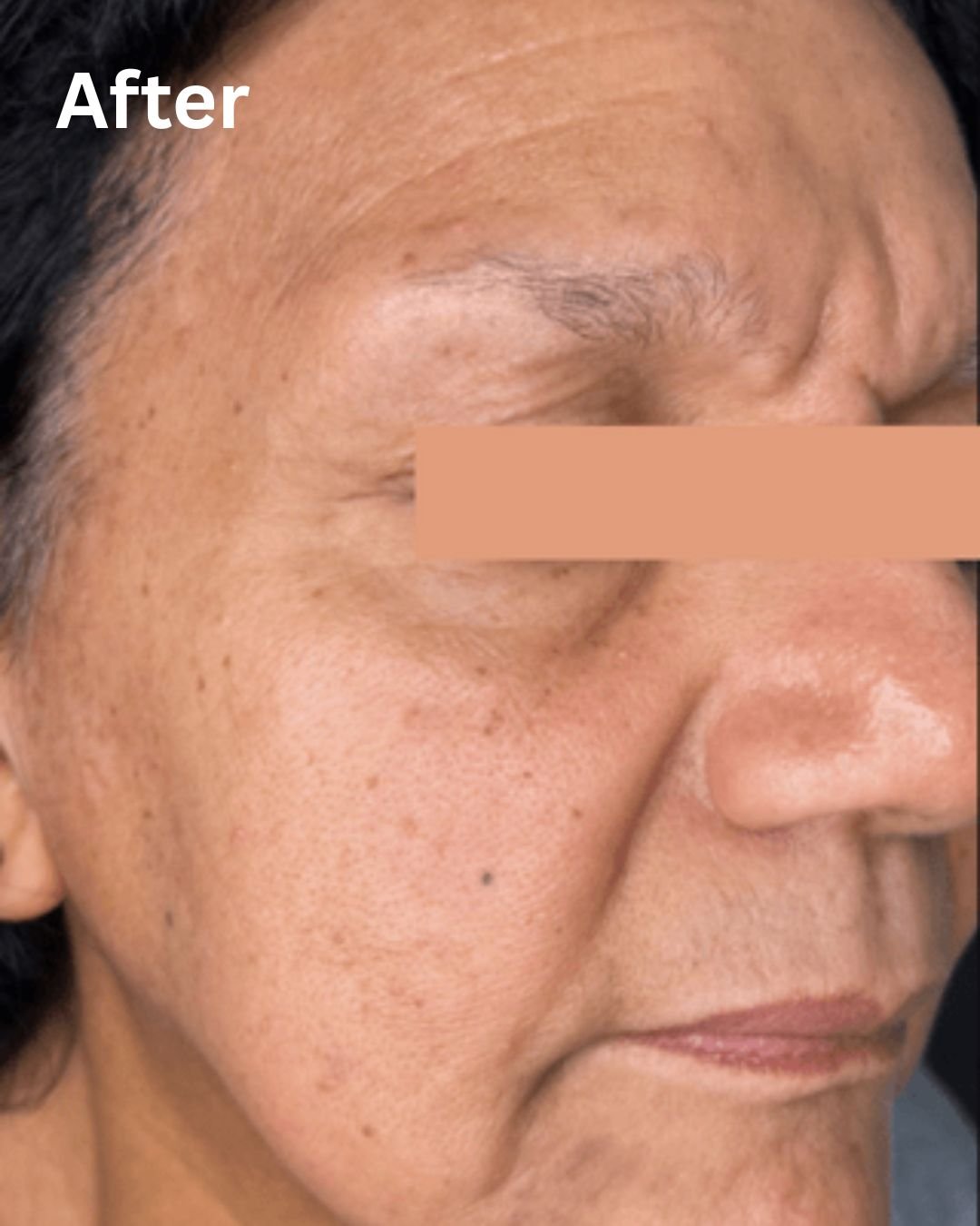 New Age Laser Clinic | Medical Spa & Laser Clinic | CoolPeel® with Tetra CO2 Laser
