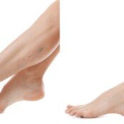 Young woman before and after varicose treatment against white background, focus on legs Before and after varicose vein treatment.