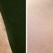 Bikini Hair Removal before and after