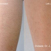 Before and after hair removal treatment.