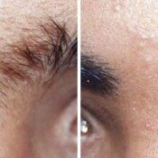 Before and after eyebrow hair removal.