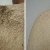 Before and after hair removal on a shoulder.