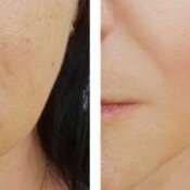 Botox & Fillers Before & After