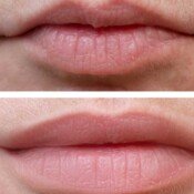Botox & Fillers Before & After
