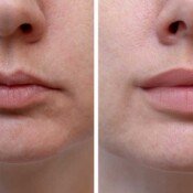 Botox & Fillers Before & After