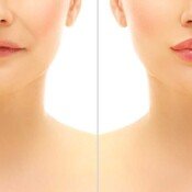 Botox & Fillers Before & After
