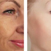 Botox & Fillers Before & After