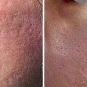 Scar Removal Before & After