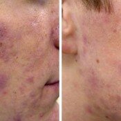 Before and after acne treatment on a face.
