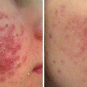 Close-up of skin before and after treatment.