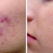 Before and after acne treatment.