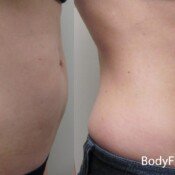 Before and after stomach contouring.