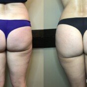 Before and after cellulite treatment.