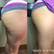 Before and after cellulite treatment.