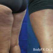 Before and after thigh treatment.