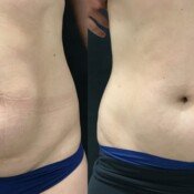 Before and after stomach treatment.