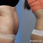Before and after body contouring results.