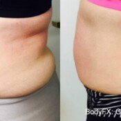 Before and after body contouring treatment.