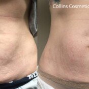 Before and after stomach treatment.