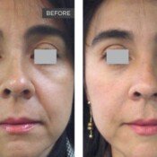 Skin Rejuvenation Before & After