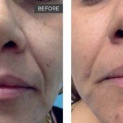 Before and after facial treatment results.