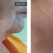 Skin Rejuvenation Before & After
