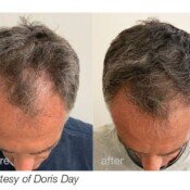 Before and after hair growth treatment.