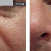 Skin Rejuvenation Before & After