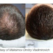 Hair loss treatment before and after.