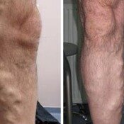 New Age Laser Clinic | Medical Spa & Laser Clinic | Veins Removal Before and after varicose vein treatment.