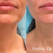 Forma Before & After