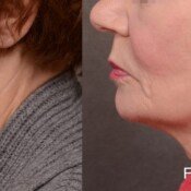 Forma Before & After