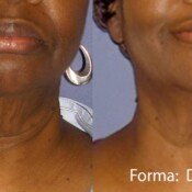 Forma Before & After