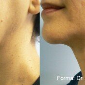 Forma Before & After