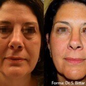 Forma Before & After
