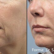 Forma Before & After