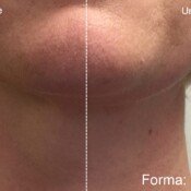 Forma Before & After
