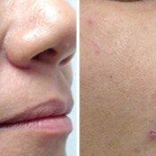 Fotona 4D Facelift Before & After