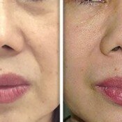 Fotona 4D Facelift Before & After
